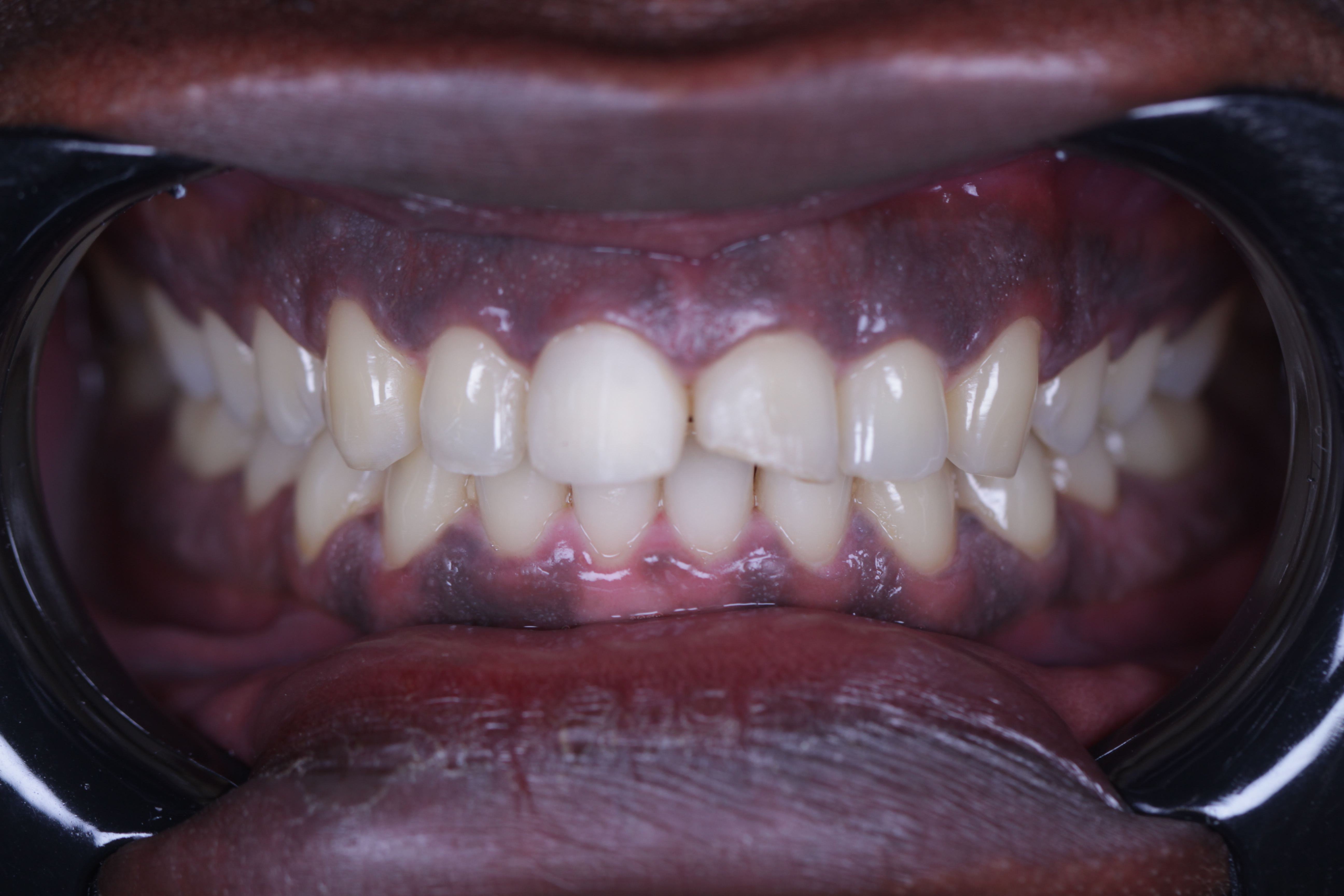 Veneers before — crowded discolored teeth, African patient, Smile Infinity® Abidjan Lebanon, Case 1