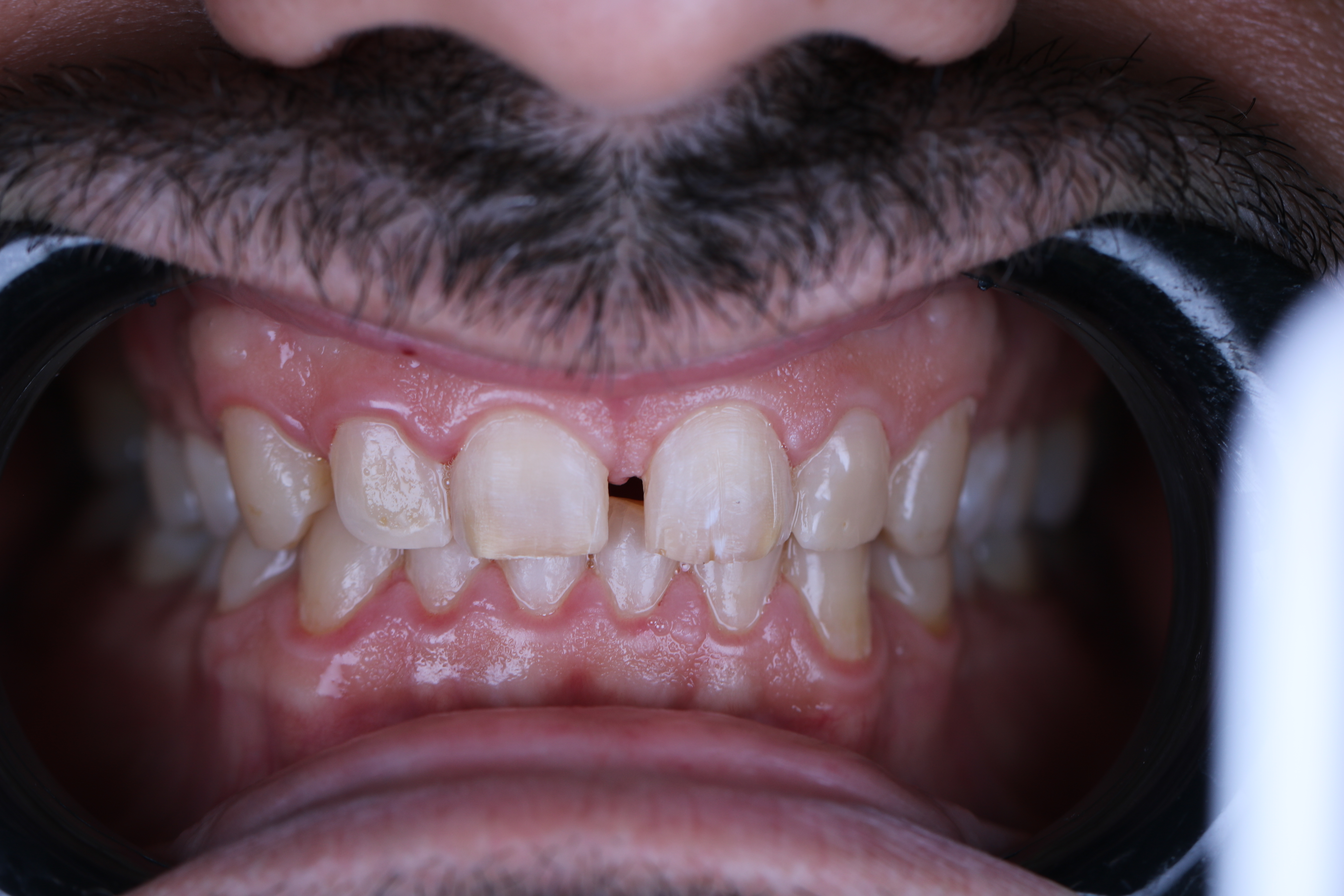 Veneers before retractor view — male patient, Lebanon, Smile Infinity®, Case 2