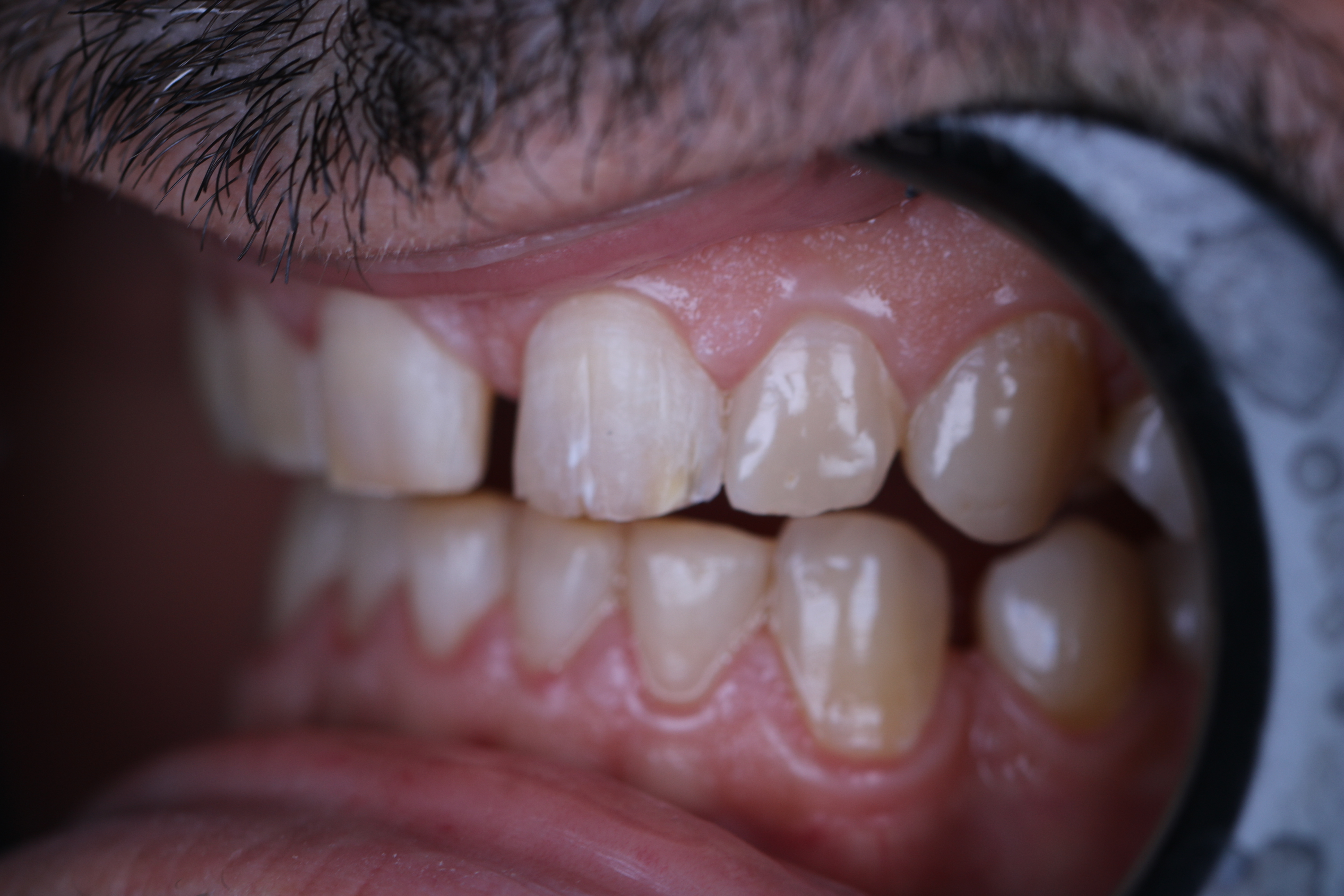 Veneers before lateral side view — male patient, Lebanon, Smile Infinity®, Case 2