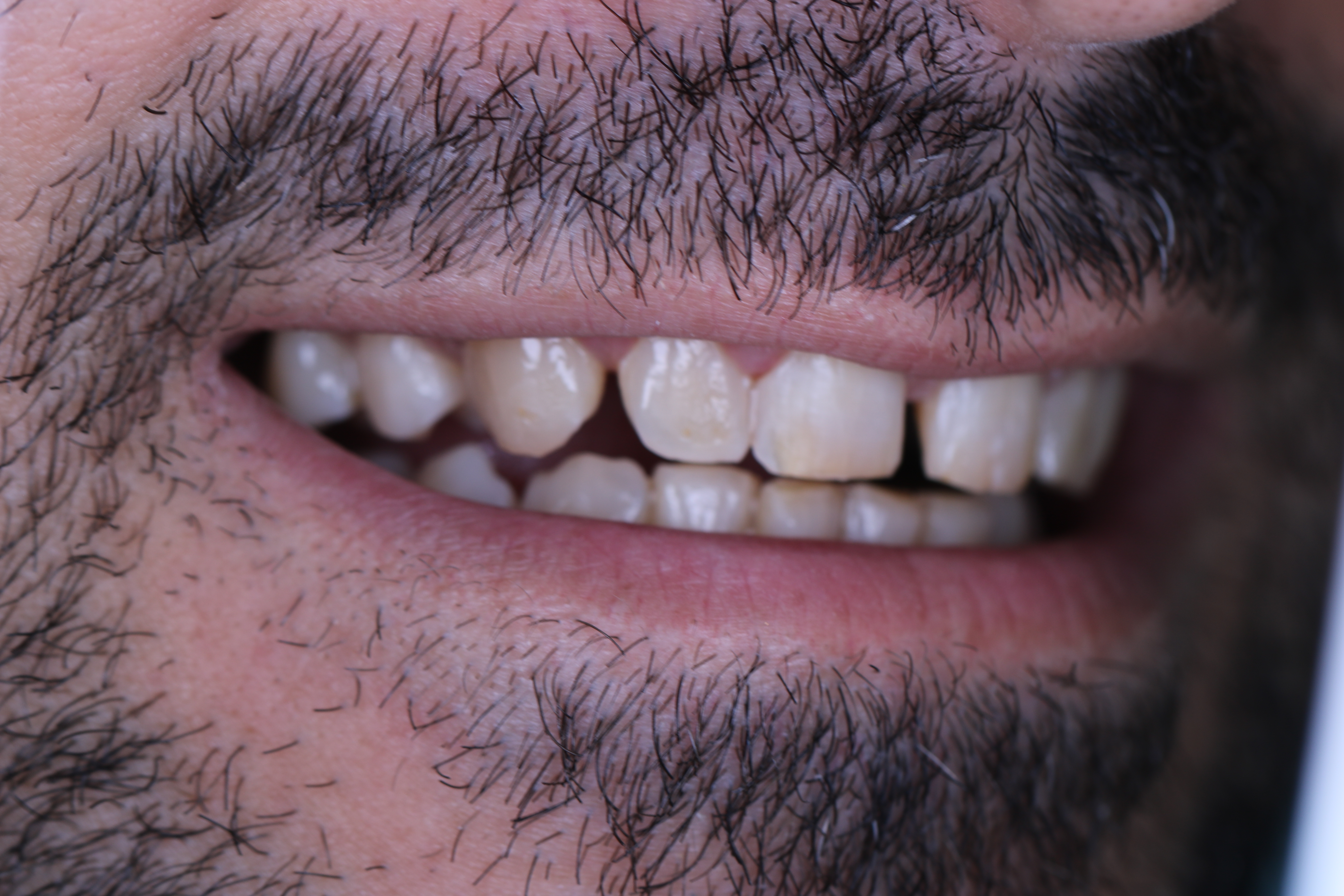 Veneers before — smile view, male patient, Lebanon, Smile Infinity®, Case 2