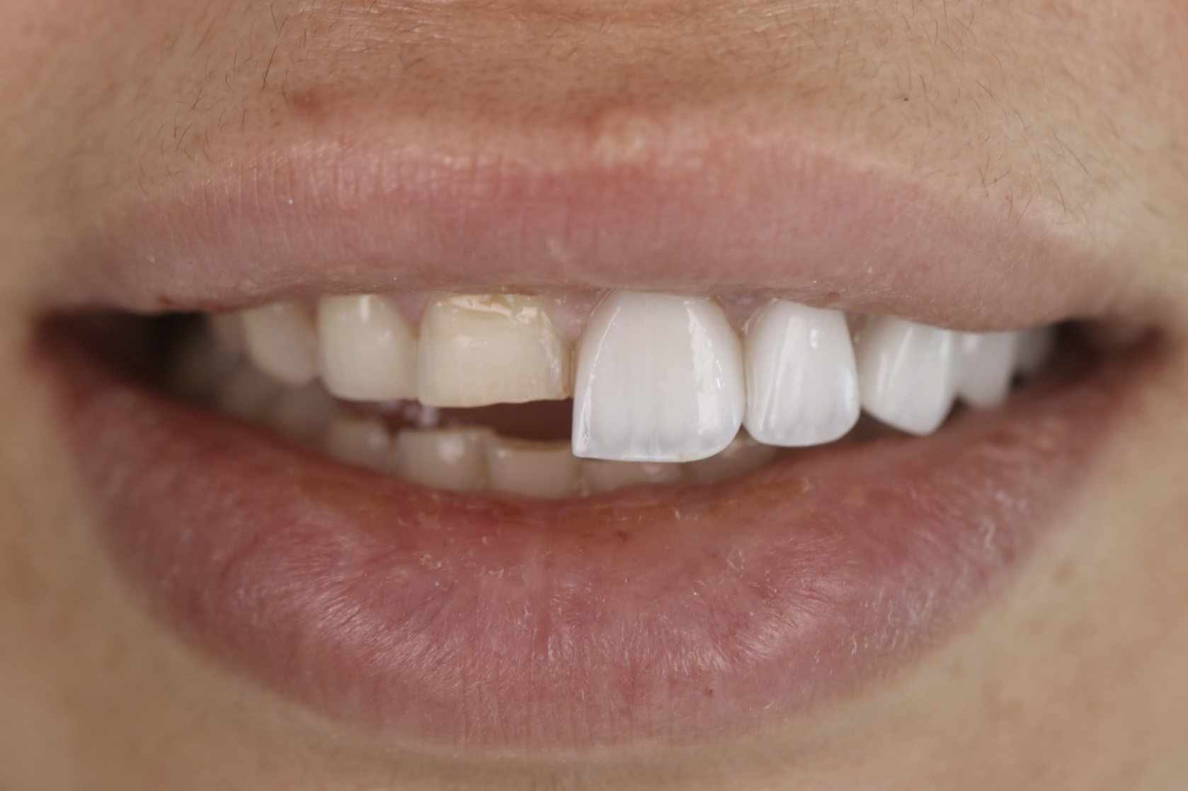 Veneers during placement — female patient, Smile Infinity® Lebanon, Case 3